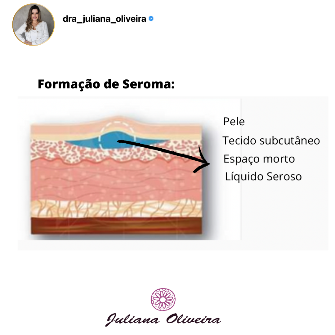 Seroma: o que é, sintomas, causas e tratamento - Tua Saúde